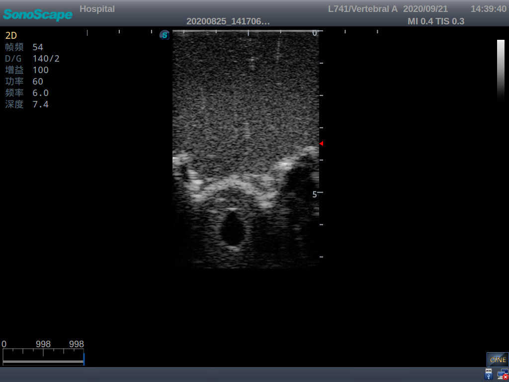 Adult Lumbar Puncture Ultrasound Training Model